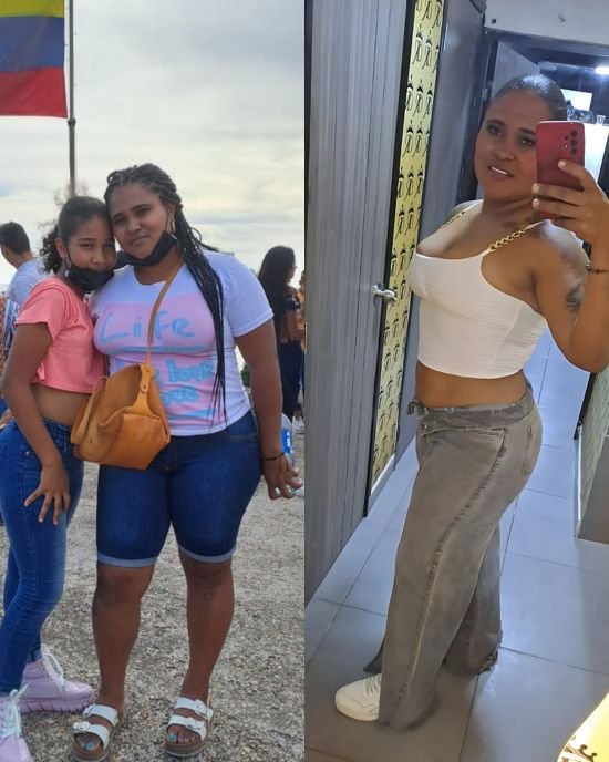 Antes y después paciente 4